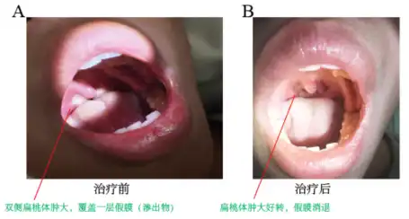 男子高热咽痛，患上“亲吻病”！这种病毒潜伏感染普遍存在