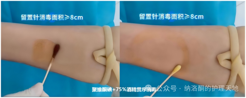 留置针“三点一线”标准化固定方案，贴膜不再松动，留置时间也延长了！