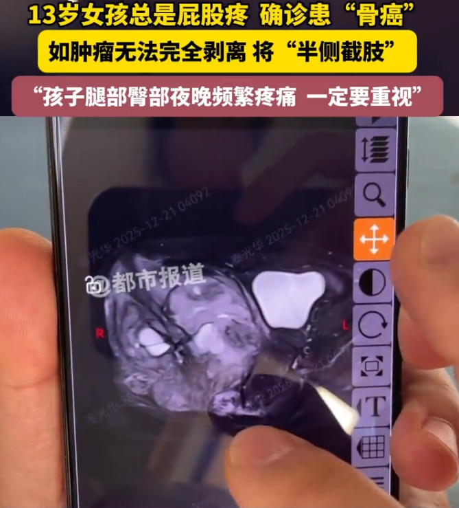 13岁女孩频繁屁股疼确诊骨癌，或需截掉一侧屁股，医生提醒